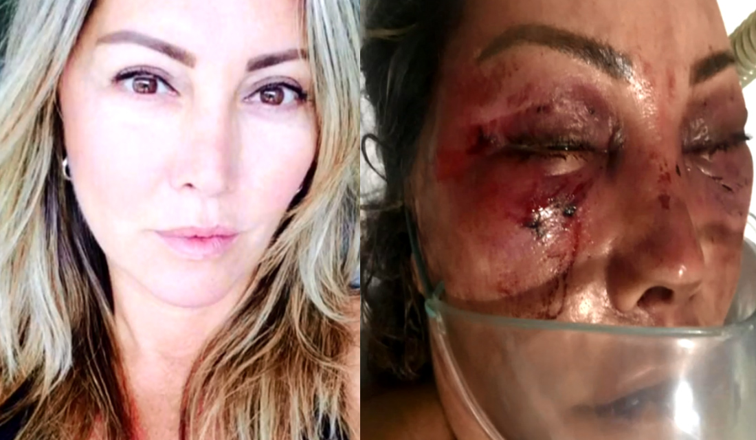 Resultado de imagem para Elaine Perez Caparroz, de 55 anos, sofreu fraturas no rosto e vai precisar de cirurgia reparadora.